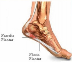 Fascite Plantar