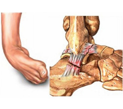 Lesões Ligamentares