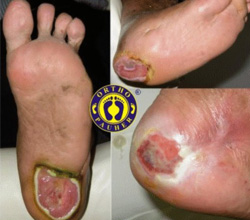 Neuropatia Periférica