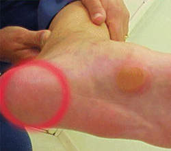 Atrofia do Coxim Plantar