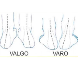 Pé Valgo e Varo